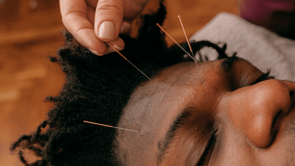 Facial acupuncture_1 | Treatwell